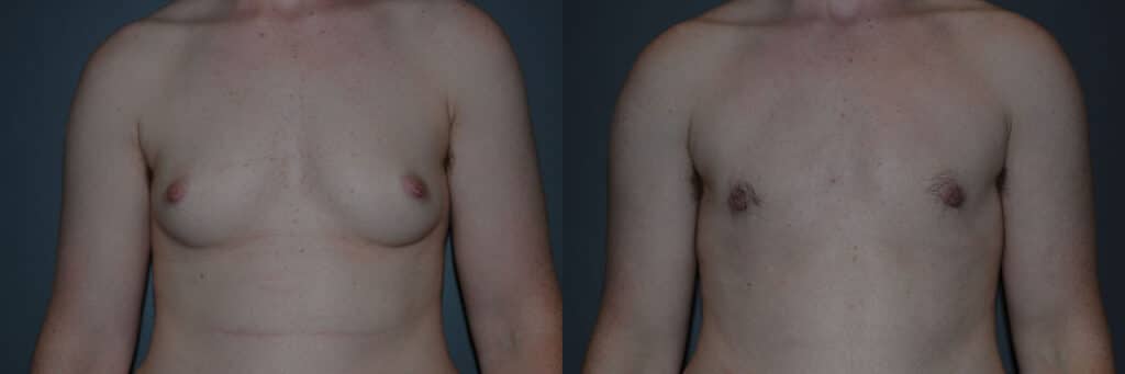 Gender Affirming Surgery before and after photo by Dr. Richard A. Bartlett in Brookline, MA