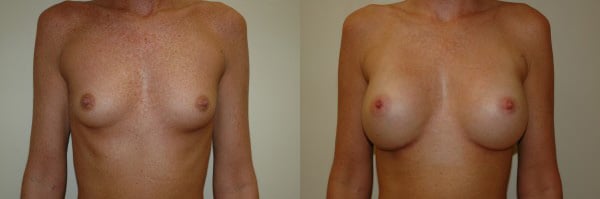 Breast Augmentation before and after photo by Dr. Richard A. Bartlett in Brookline, MA