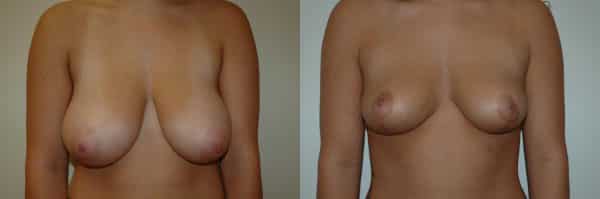 Breast Reduction before and after photo by Dr. Richard A. Bartlett in Brookline, MA