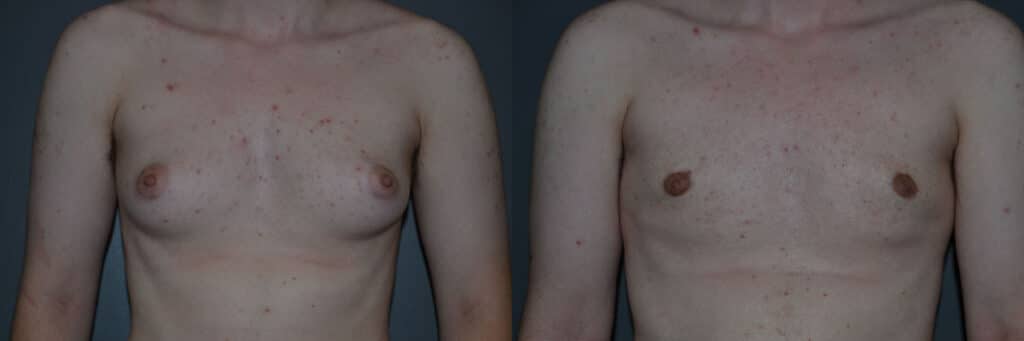 Gender Affirming Surgery before and after photo by Dr. Richard A. Bartlett in Brookline, MA