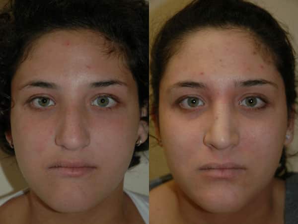 Rhinoplasty (Nose Surgery) before and after photo by Dr. Richard A. Bartlett in Brookline, MA