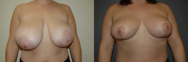 Breast Reduction before and after photo by Dr. Richard A. Bartlett in Brookline, MA