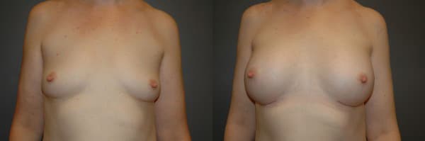 Breast Augmentation before and after photo by Dr. Richard A. Bartlett in Brookline, MA