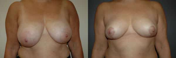 Breast Reduction before and after photo by Dr. Richard A. Bartlett in Brookline, MA