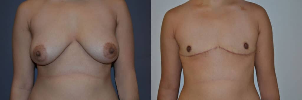 Gender Affirming Surgery before and after photo by Dr. Richard A. Bartlett in Brookline, MA