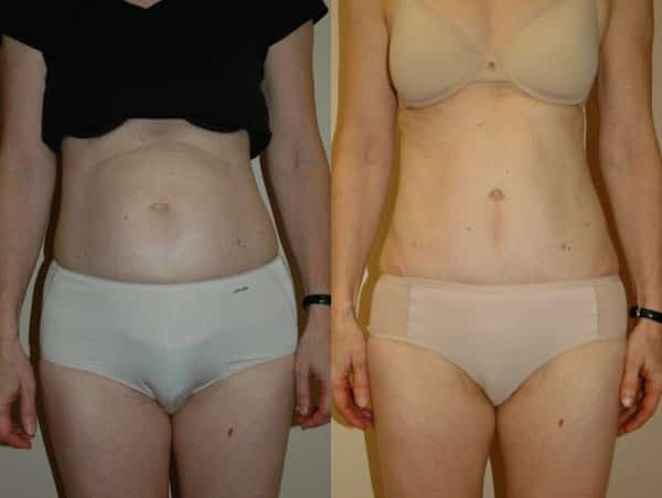 Abdominoplasty (Tummy Tuck) before and after photo by Dr. Richard A. Bartlett in Brookline, MA