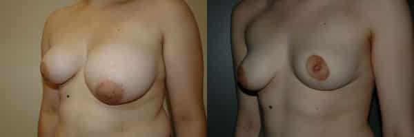 Breast Asymmetry before and after photo by Dr. Richard A. Bartlett in Brookline, MA