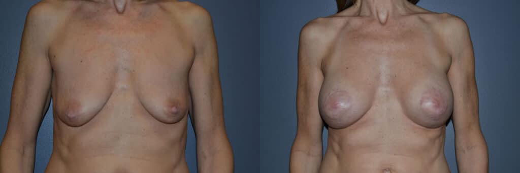 Breast Augmentation before and after photo by Dr. Richard A. Bartlett in Brookline, MA