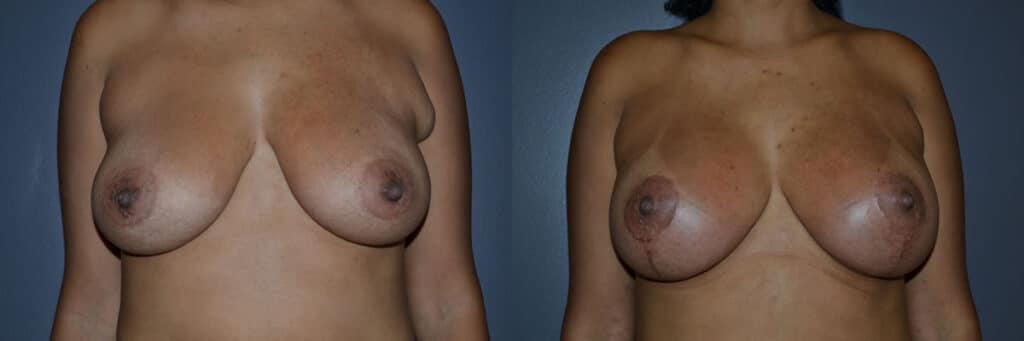 Breast Lift before and after photo by Dr. Richard A. Bartlett in Brookline, MA