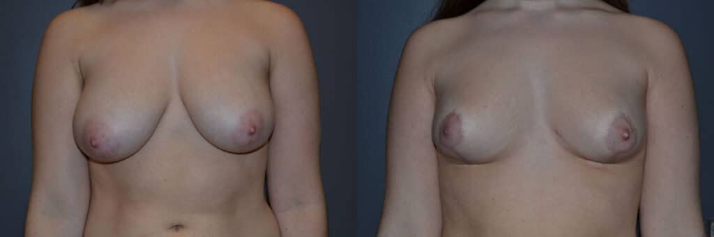 Breast Reduction before and after photo by Dr. Richard A. Bartlett in Brookline, MA