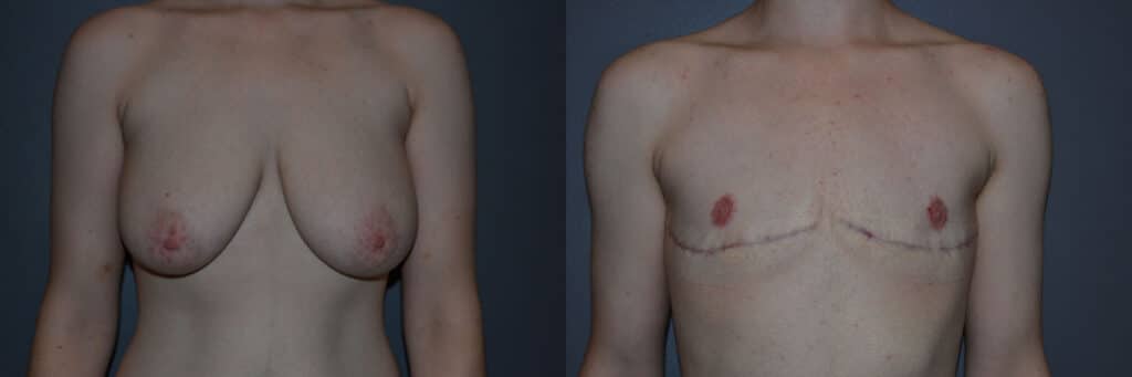 Gender Affirming Surgery before and after photo by Dr. Richard A. Bartlett in Brookline, MA