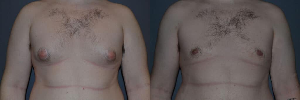 Gynecomastia (Male Breast Reduction) before and after photo by Dr. Richard A. Bartlett in Brookline, MA