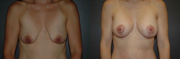 Breast Augmentation before and after photo by Dr. Richard A. Bartlett in Brookline, MA