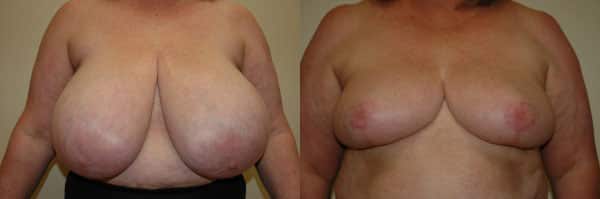 Breast Reduction before and after photo by Dr. Richard A. Bartlett in Brookline, MA