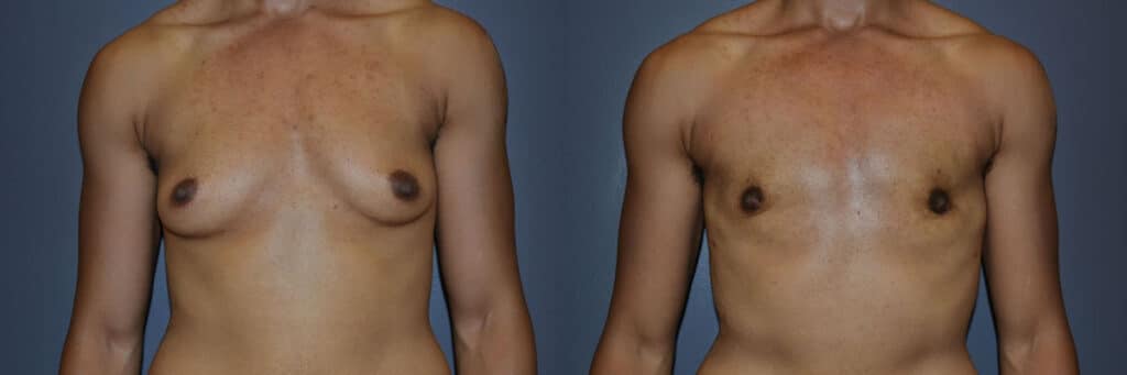 Gender Affirming Surgery before and after photo by Dr. Richard A. Bartlett in Brookline, MA