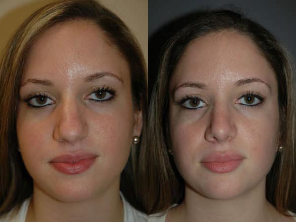 Rhinoplasty (Nose Surgery) before and after photo by Dr. Richard A. Bartlett in Brookline, MA