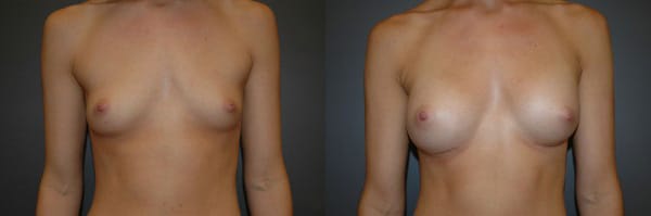 Breast Augmentation before and after photo by Dr. Richard A. Bartlett in Brookline, MA