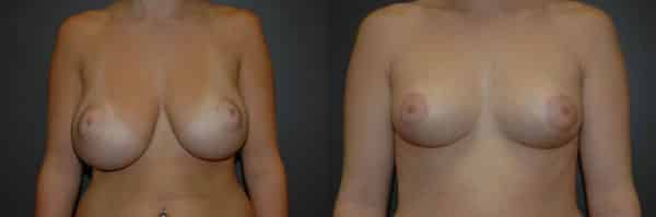 Breast Reduction before and after photo by Dr. Richard A. Bartlett in Brookline, MA