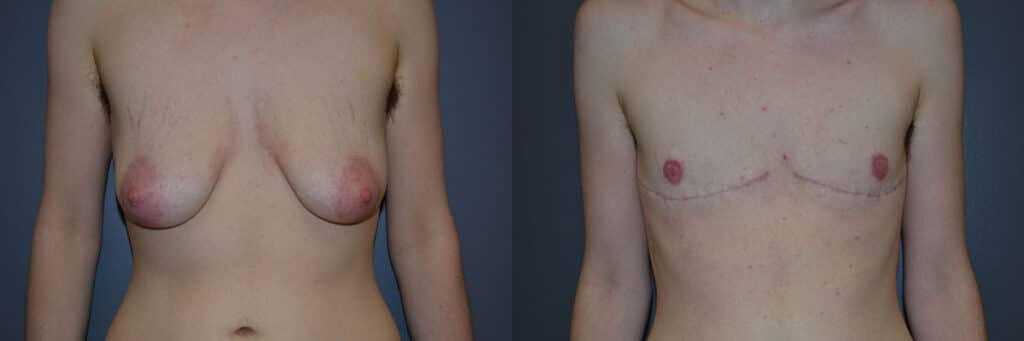 Gender Affirming Surgery before and after photo by Dr. Richard A. Bartlett in Brookline, MA