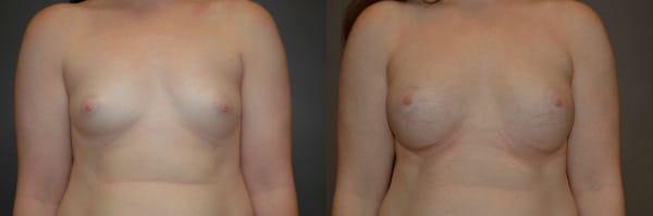 Breast Augmentation before and after photo by Dr. Richard A. Bartlett in Brookline, MA