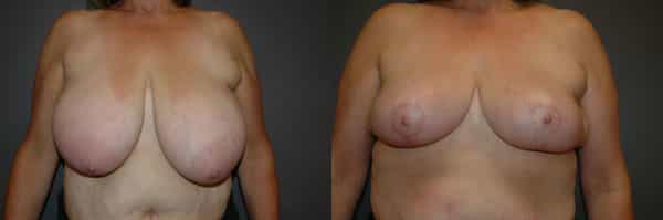 Breast Reduction before and after photo by Dr. Richard A. Bartlett in Brookline, MA