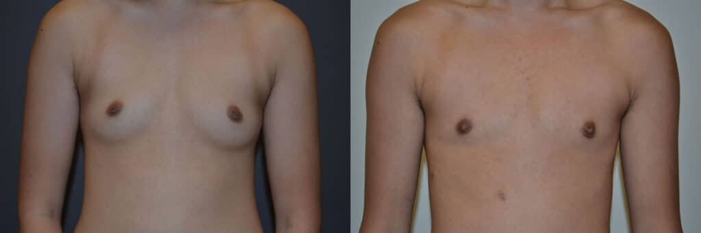 Gender Affirming Surgery before and after photo by Dr. Richard A. Bartlett in Brookline, MA