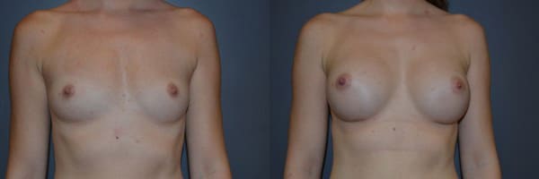 Breast Augmentation before and after photo by Dr. Richard A. Bartlett in Brookline, MA