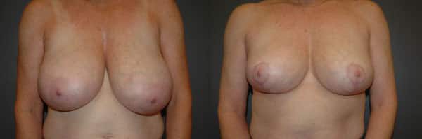 Breast Reduction before and after photo by Dr. Richard A. Bartlett in Brookline, MA