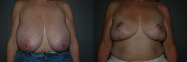 Breast Reduction before and after photo by Dr. Richard A. Bartlett in Brookline, MA