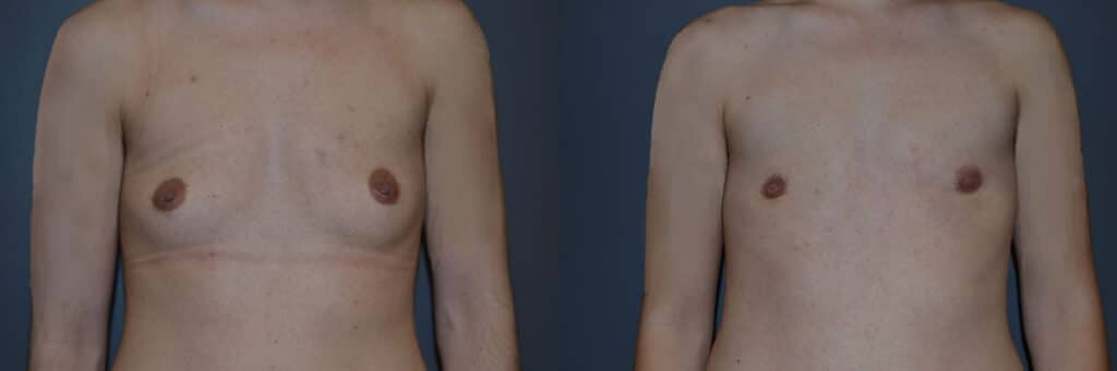 Gender Affirming Surgery before and after photo by Dr. Richard A. Bartlett in Brookline, MA