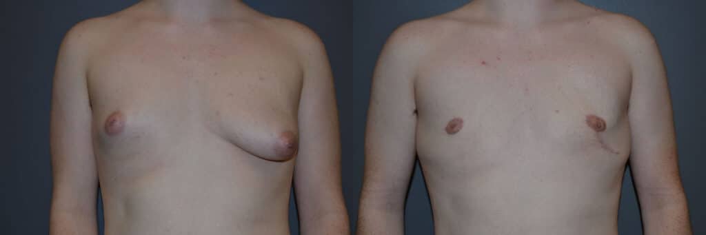 Gender Affirming Surgery before and after photo by Dr. Richard A. Bartlett in Brookline, MA