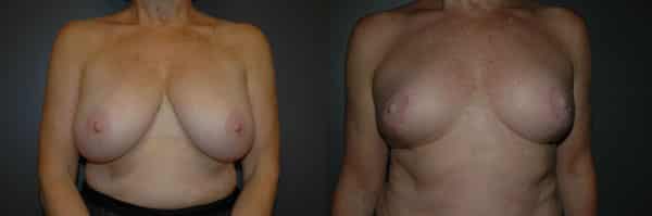 Breast Reduction before and after photo by Dr. Richard A. Bartlett in Brookline, MA