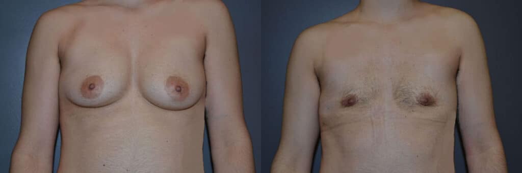 Gender Affirming Surgery before and after photo by Dr. Richard A. Bartlett in Brookline, MA