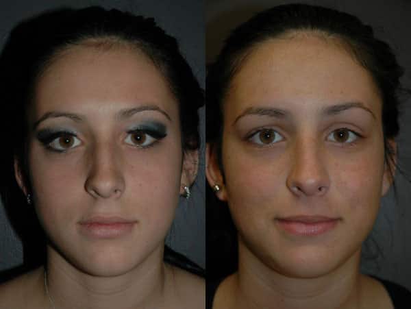 Rhinoplasty (Nose Surgery) before and after photo by Dr. Richard A. Bartlett in Brookline, MA