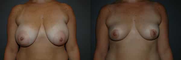 Breast Reduction before and after photo by Dr. Richard A. Bartlett in Brookline, MA