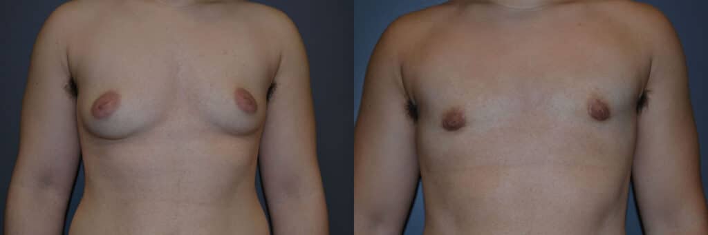Gender Affirming Surgery before and after photo by Dr. Richard A. Bartlett in Brookline, MA