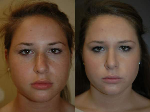 Rhinoplasty (Nose Surgery) before and after photo by Dr. Richard A. Bartlett in Brookline, MA