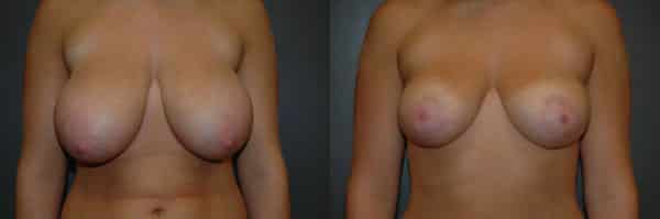 Breast Reduction before and after photo by Dr. Richard A. Bartlett in Brookline, MA