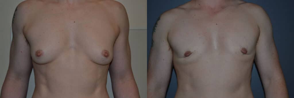 Gender Affirming Surgery before and after photo by Dr. Richard A. Bartlett in Brookline, MA