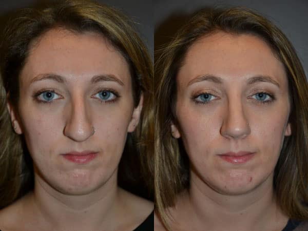 Rhinoplasty (Nose Surgery) before and after photo by Dr. Richard A. Bartlett in Brookline, MA