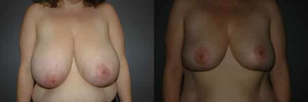 Breast Reduction before and after photo by Dr. Richard A. Bartlett in Brookline, MA