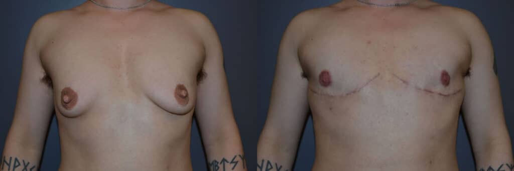 Gender Affirming Surgery before and after photo by Dr. Richard A. Bartlett in Brookline, MA