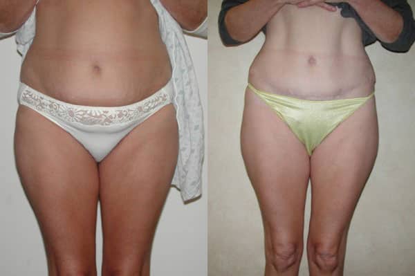 Abdominoplasty (Tummy Tuck) before and after photo by Dr. Richard A. Bartlett in Brookline, MA