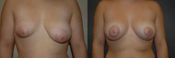 Breast Asymmetry before and after photo by Dr. Richard A. Bartlett in Brookline, MA