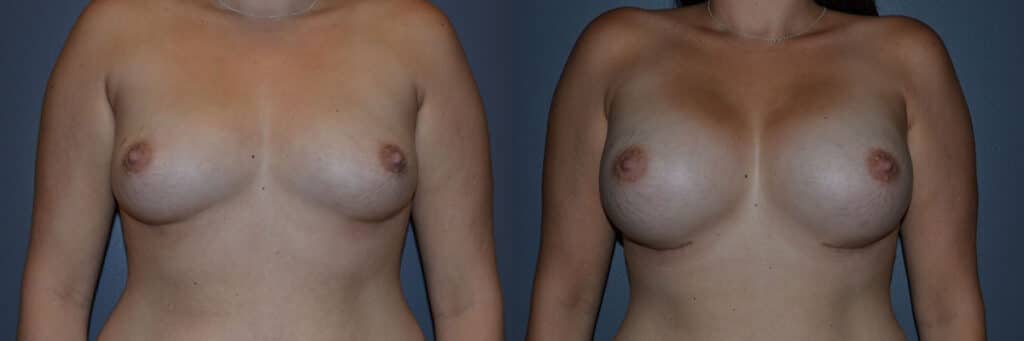 Breast Augmentation before and after photo by Dr. Richard A. Bartlett in Brookline, MA