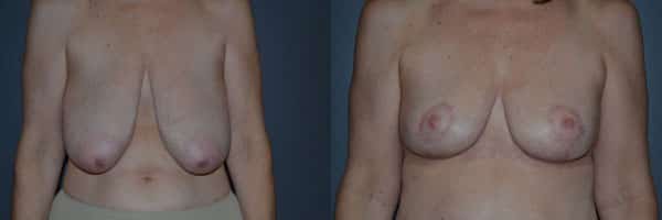 Breast Reduction before and after photo by Dr. Richard A. Bartlett in Brookline, MA