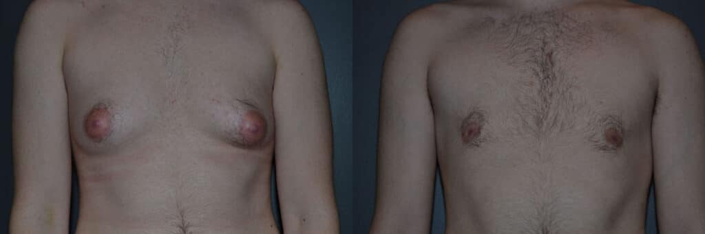 Gender Affirming Surgery before and after photo by Dr. Richard A. Bartlett in Brookline, MA