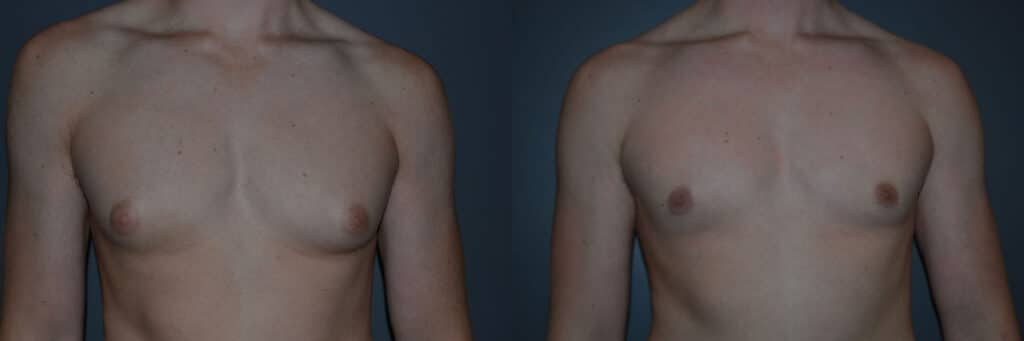 Gynecomastia (Male Breast Reduction) before and after photo by Dr. Richard A. Bartlett in Brookline, MA