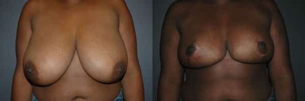 Breast Reduction before and after photo by Dr. Richard A. Bartlett in Brookline, MA