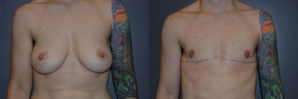 Gender Affirming Surgery before and after photo by Dr. Richard A. Bartlett in Brookline, MA